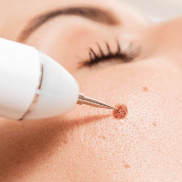 Brown Spot/Mole/Skin Tag Removal