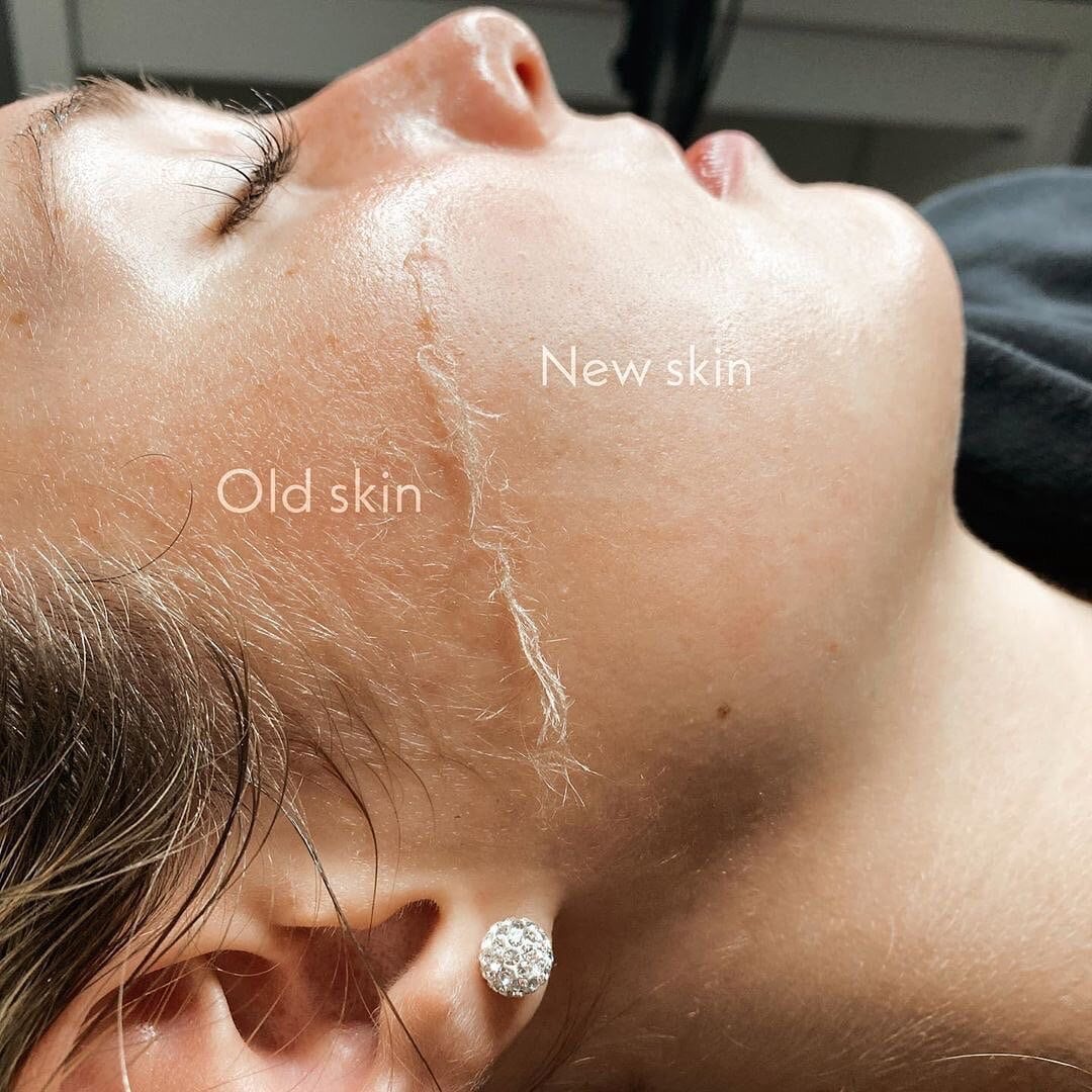 Dermaplane
